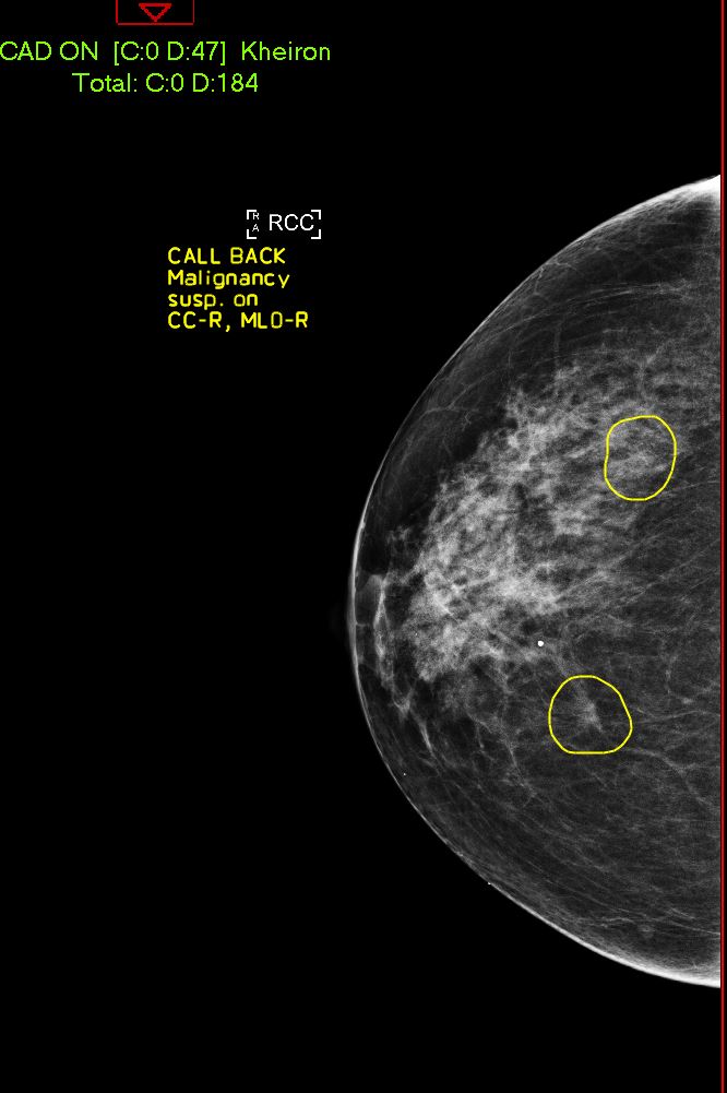 Mammogram reviewed by AI, showing areas to review