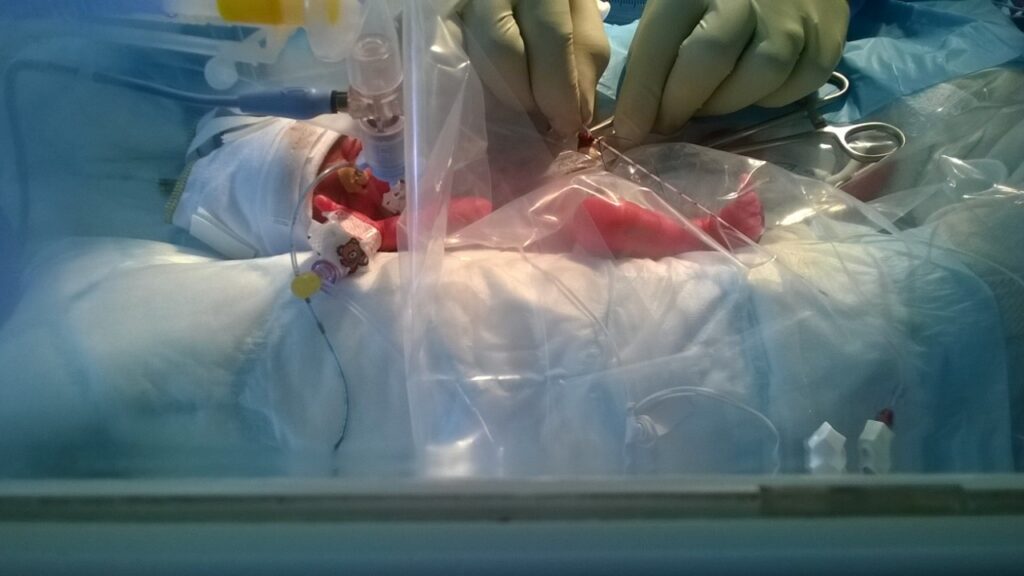 Baby Freddie Dolan was just 1lb when he was born